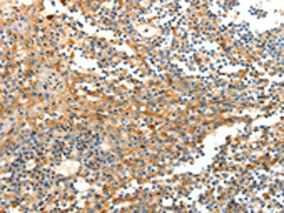 The image on the left is immunohistochemistry of paraffin-embedded Human tonsil tissue using CSB-PA026205(DTX3 Antibody) at dilution 1/20, on the right is treated with fusion protein. (Original magnification: x200) The image on the left is immunohistochemistry of paraffin-embedded Human tonsil tissue using CSB-PA026205(DTX3 Antibody) at dilution 1/20, on the right is treated with fusion protein. (Original magnification: x200)
