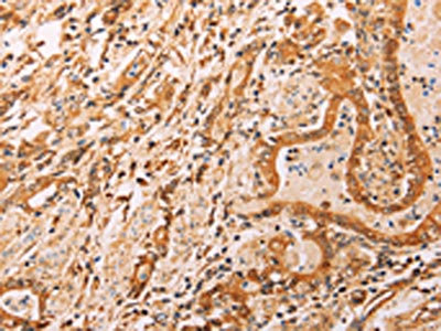 The image on the left is immunohistochemistry of paraffin-embedded Human gastic cancer tissue using CSB-PA027485(ADH1B Antibody) at dilution 1/40, on the right is treated with synthetic peptide. (Original magnification: x200)