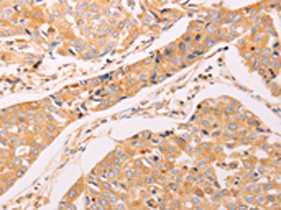 The image on the left is immunohistochemistry of paraffin-embedded Human breast cancer tissue using CSB-PA027485(ADH1B Antibody) at dilution 1/40, on the right is treated with synthetic peptide. (Original magnification: x200) The image on the left is immunohistochemistry of paraffin-embedded Human breast cancer tissue using CSB-PA027485(ADH1B Antibody) at dilution 1/40, on the right is treated with synthetic peptide. (Original magnification: x200)