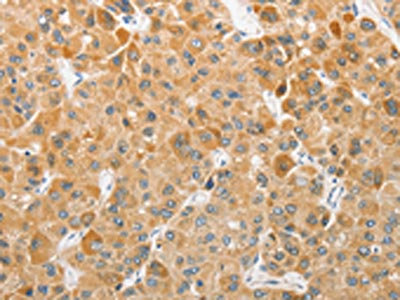 The image on the left is immunohistochemistry of paraffin-embedded Human liver cancer tissue using CSB-PA028037(ATG5 Antibody) at dilution 1/40, on the right is treated with fusion protein. (Original magnification: x200)