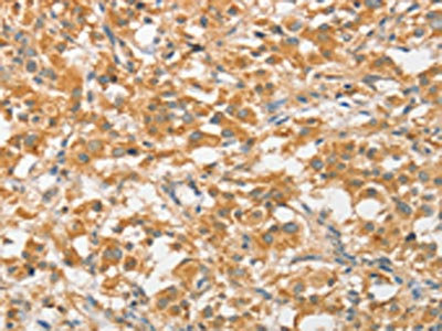 The image on the left is immunohistochemistry of paraffin-embedded Human thyroid cancer tissue using CSB-PA028037(ATG5 Antibody) at dilution 1/40, on the right is treated with fusion protein. (Original magnification: x200) The image on the left is immunohistochemistry of paraffin-embedded Human thyroid cancer tissue using CSB-PA028037(ATG5 Antibody) at dilution 1/40, on the right is treated with fusion protein. (Original magnification: x200)