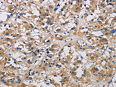 The image is immunohistochemistry of paraffin-embedded Human thyroid cancer tissue using CSB-PA029843(ARF6 Antibody) at dilution 1/20. (Original magnification: x200)