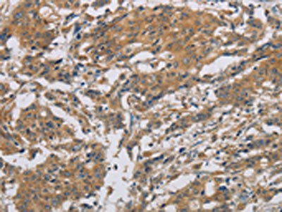 The image is immunohistochemistry of paraffin-embedded Human gastic cancer tissue using CSB-PA029843(ARF6 Antibody) at dilution 1/20. (Original magnification: x200) The image is immunohistochemistry of paraffin-embedded Human gastic cancer tissue using CSB-PA029843(ARF6 Antibody) at dilution 1/20. (Original magnification: x200)