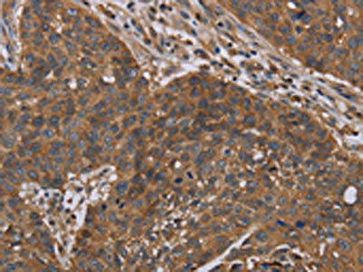 The image on the left is immunohistochemistry of paraffin-embedded Human lung cancer tissue using CSB-PA029863(OXTR Antibody) at dilution 1/40, on the right is treated with synthetic peptide. (Original magnification: x200) The image on the left is immunohistochemistry of paraffin-embedded Human lung cancer tissue using CSB-PA029863(OXTR Antibody) at dilution 1/40, on the right is treated with synthetic peptide. (Original magnification: x200)