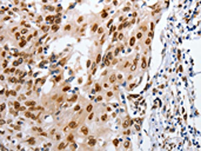 The image on the left is immunohistochemistry of paraffin-embedded Human cervical cancer tissue using CSB-PA029874(MUTYH Antibody) at dilution 1/25, on the right is treated with fusion protein. (Original magnification: x200)