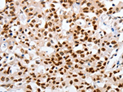 The image on the left is immunohistochemistry of paraffin-embedded Human lung cancer tissue using CSB-PA029874(MUTYH Antibody) at dilution 1/25, on the right is treated with fusion protein. (Original magnification: x200) The image on the left is immunohistochemistry of paraffin-embedded Human lung cancer tissue using CSB-PA029874(MUTYH Antibody) at dilution 1/25, on the right is treated with fusion protein. (Original magnification: x200)