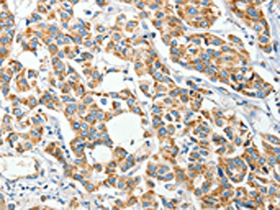 The image on the left is immunohistochemistry of paraffin-embedded Human breast cancer tissue using CSB-PA040376(IFT74 Antibody) at dilution 1/60, on the right is treated with synthetic peptide. (Original magnification: x200)