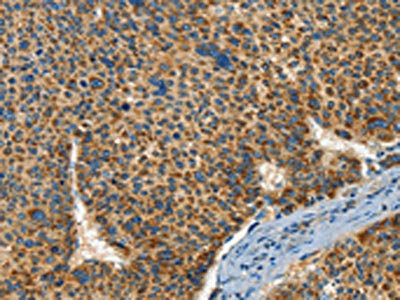 The image on the left is immunohistochemistry of paraffin-embedded Human liver cancer tissue using CSB-PA040376(IFT74 Antibody) at dilution 1/60, on the right is treated with synthetic peptide. (Original magnification: x200)