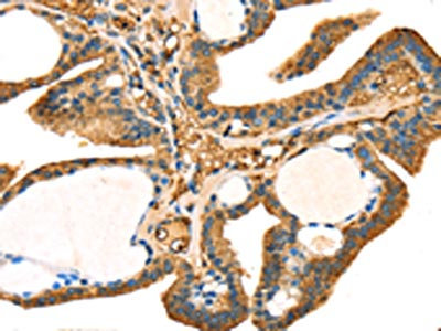 The image on the left is immunohistochemistry of paraffin-embedded Human thyroid cancer tissue using CSB-PA041704(STX18 Antibody) at dilution 1/25, on the right is treated with fusion protein. (Original magnification: x200)