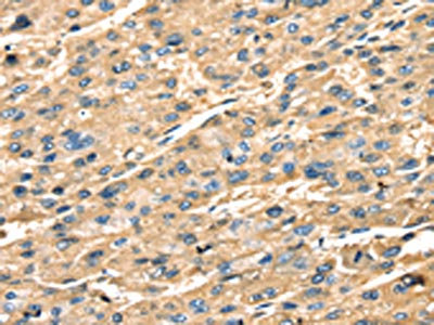 The image on the left is immunohistochemistry of paraffin-embedded Human liver cancer tissue using CSB-PA041704(STX18 Antibody) at dilution 1/25, on the right is treated with fusion protein. (Original magnification: x200)