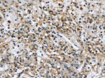 The image on the left is immunohistochemistry of paraffin-embedded Human prostate cancer tissue using CSB-PA042084(USP28 Antibody) at dilution 1/35, on the right is treated with synthetic peptide. (Original magnification: x200)