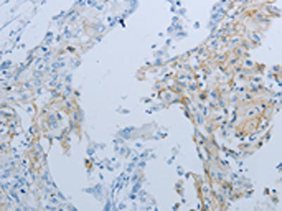 The image on the left is immunohistochemistry of paraffin-embedded Human cervical cancer tissue using CSB-PA044408(JUP Antibody) at dilution 1/25, on the right is treated with synthetic peptide. (Original magnification: x200)
