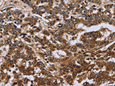 The image on the left is immunohistochemistry of paraffin-embedded Human liver cancer tissue using CSB-PA045962(FH Antibody) at dilution 1/30, on the right is treated with fusion protein. (Original magnification: x200)