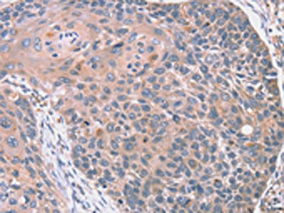 The image on the left is immunohistochemistry of paraffin-embedded Human esophagus cancer tissue using CSB-PA053220(RGS10 Antibody) at dilution 1/20, on the right is treated with fusion protein. (Original magnification: x200)