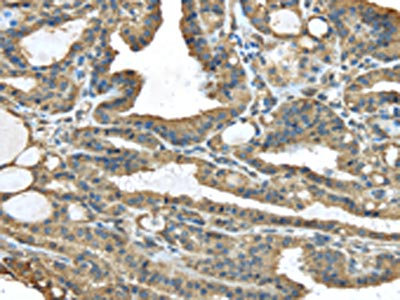 The image on the left is immunohistochemistry of paraffin-embedded Human thyroid cancer tissue using CSB-PA053790(TMED1 Antibody) at dilution 1/35, on the right is treated with fusion protein. (Original magnification: x200)