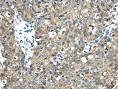 The image on the left is immunohistochemistry of paraffin-embedded Human breast cancer tissue using CSB-PA053790(TMED1 Antibody) at dilution 1/35, on the right is treated with fusion protein. (Original magnification: x200)
