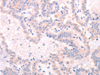 The image on the left is immunohistochemistry of paraffin-embedded Human thyroid cancer tissue using CSB-PA056378(INA Antibody) at dilution 1/25, on the right is treated with synthetic peptide. (Original magnification: x200) The image on the left is immunohistochemistry of paraffin-embedded Human thyroid cancer tissue using CSB-PA056378(INA Antibody) at dilution 1/25, on the right is treated with synthetic peptide. (Original magnification: x200)
