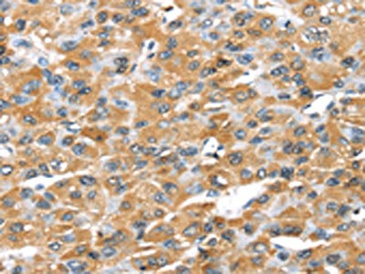The image on the left is immunohistochemistry of paraffin-embedded Human liver cancer tissue using CSB-PA057029(GZMK Antibody) at dilution 1/20, on the right is treated with synthetic peptide. (Original magnification: x200)