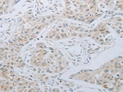 The image on the left is immunohistochemistry of paraffin-embedded Human lung cancer tissue using CSB-PA061510(LOX Antibody) at dilution 1/30, on the right is treated with synthetic peptide. (Original magnification: x200)