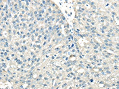 The image on the left is immunohistochemistry of paraffin-embedded Human breast cancer tissue using CSB-PA068002(VPS36 Antibody) at dilution 1/40, on the right is treated with synthetic peptide. (Original magnification: x200) The image on the left is immunohistochemistry of paraffin-embedded Human breast cancer tissue using CSB-PA068002(VPS36 Antibody) at dilution 1/40, on the right is treated with synthetic peptide. (Original magnification: x200)