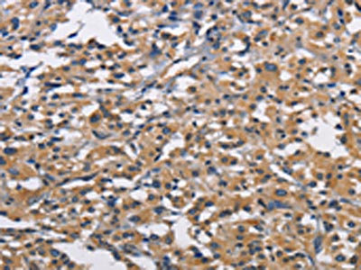 The image on the left is immunohistochemistry of paraffin-embedded Human thyroid cancer tissue using CSB-PA068175(CBY1 Antibody) at dilution 1/60, on the right is treated with fusion protein. (Original magnification: x200)