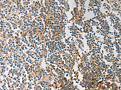 The image on the left is immunohistochemistry of paraffin-embedded Human tonsil tissue using CSB-PA077190(PRMT5 Antibody) at dilution 1/20, on the right is treated with synthetic peptide. (Original magnification: x200)