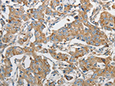 The image on the left is immunohistochemistry of paraffin-embedded Human breast cancer tissue using CSB-PA077190(PRMT5 Antibody) at dilution 1/20, on the right is treated with synthetic peptide. (Original magnification: x200)