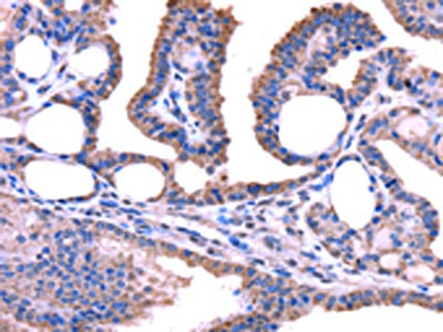 The image on the left is immunohistochemistry of paraffin-embedded Human thyroid cancer tissue using CSB-PA080676(TRIM49 Antibody) at dilution 1/40, on the right is treated with fusion protein. (Original magnification: x200)