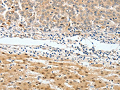 The image on the left is immunohistochemistry of paraffin-embedded Human lung cancer tissue using CSB-PA086320(BPIFB2 Antibody) at dilution 1/45, on the right is treated with synthetic peptide. (Original magnification: x200)