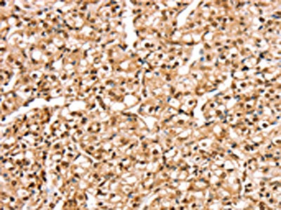 The image on the left is immunohistochemistry of paraffin-embedded Human prostate cancer tissue using CSB-PA088935(STK32B Antibody) at dilution 1/25, on the right is treated with synthetic peptide. (Original magnification: x200)