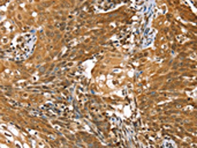 The image on the left is immunohistochemistry of paraffin-embedded Human cervical cancer tissue using CSB-PA088935(STK32B Antibody) at dilution 1/25, on the right is treated with synthetic peptide. (Original magnification: x200)