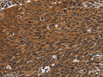 The image on the left is immunohistochemistry of paraffin-embedded Human cervical cancer tissue using CSB-PA090243(PNOC Antibody) at dilution 1/40, on the right is treated with synthetic peptide. (Original magnification: x200) The image on the left is immunohistochemistry of paraffin-embedded Human cervical cancer tissue using CSB-PA090243(PNOC Antibody) at dilution 1/40, on the right is treated with synthetic peptide. (Original magnification: x200)
