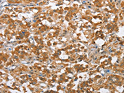 The image on the left is immunohistochemistry of paraffin-embedded Human thyroid cancer tissue using CSB-PA091025(MLH1 Antibody) at dilution 1/60, on the right is treated with fusion protein. (Original magnification: x200)