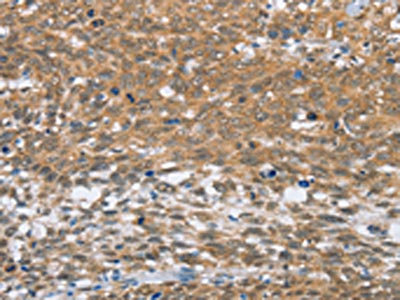 The image on the left is immunohistochemistry of paraffin-embedded Human cervical cancer tissue using CSB-PA091025(MLH1 Antibody) at dilution 1/60, on the right is treated with fusion protein. (Original magnification: x200) The image on the left is immunohistochemistry of paraffin-embedded Human cervical cancer tissue using CSB-PA091025(MLH1 Antibody) at dilution 1/60, on the right is treated with fusion protein. (Original magnification: x200)