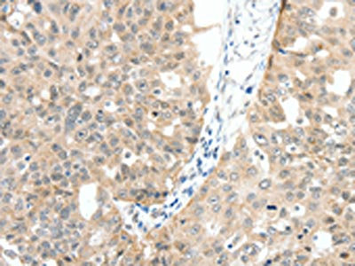 The image on the left is immunohistochemistry of paraffin-embedded Human ovarian cancer tissue using CSB-PA091701(MAP3K14 Antibody) at dilution 1/30, on the right is treated with fusion protein. (Original magnification: x200)
