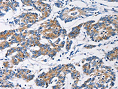 The image on the left is immunohistochemistry of paraffin-embedded Human colon cancer tissue using CSB-PA093794(HK1 Antibody) at dilution 1/50, on the right is treated with fusion protein. (Original magnification: x200)