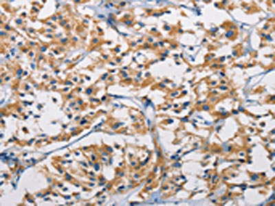 The image on the left is immunohistochemistry of paraffin-embedded Human thyroid cancer tissue using CSB-PA093794(HK1 Antibody) at dilution 1/50, on the right is treated with fusion protein. (Original magnification: x200) The image on the left is immunohistochemistry of paraffin-embedded Human thyroid cancer tissue using CSB-PA093794(HK1 Antibody) at dilution 1/50, on the right is treated with fusion protein. (Original magnification: x200)