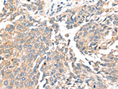 The image on the left is immunohistochemistry of paraffin-embedded Human lung cancer tissue using CSB-PA094289(SIRT4 Antibody) at dilution 1/35, on the right is treated with synthetic peptide. (Original magnification: x200)