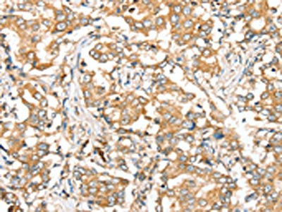 The image on the left is immunohistochemistry of paraffin-embedded Human liver cancer tissue using CSB-PA094289(SIRT4 Antibody) at dilution 1/35, on the right is treated with synthetic peptide. (Original magnification: x200)