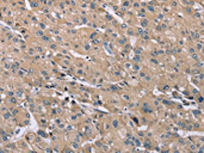 The image on the left is immunohistochemistry of paraffin-embedded Human liver cancer tissue using CSB-PA095524(SAMD9L Antibody) at dilution 1/30, on the right is treated with synthetic peptide. (Original magnification: x200)