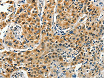 The image on the left is immunohistochemistry of paraffin-embedded Human lung cancer tissue using CSB-PA097824(PFDN6 Antibody) at dilution 1/35, on the right is treated with synthetic peptide. (Original magnification: x200)