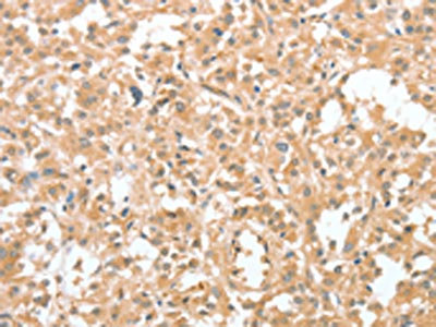 The image on the left is immunohistochemistry of paraffin-embedded Human thyroid cancer tissue using CSB-PA102580(CIAPIN1 Antibody) at dilution 1/60, on the right is treated with fusion protein. (Original magnification: x200) The image on the left is immunohistochemistry of paraffin-embedded Human thyroid cancer tissue using CSB-PA102580(CIAPIN1 Antibody) at dilution 1/60, on the right is treated with fusion protein. (Original magnification: x200)
