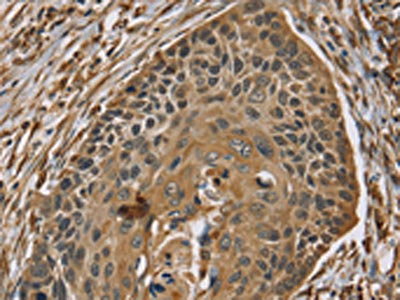The image on the left is immunohistochemistry of paraffin-embedded Human esophagus cancer tissue using CSB-PA103365(ZMIZ1 Antibody) at dilution 1/40, on the right is treated with synthetic peptide. (Original magnification: x200)