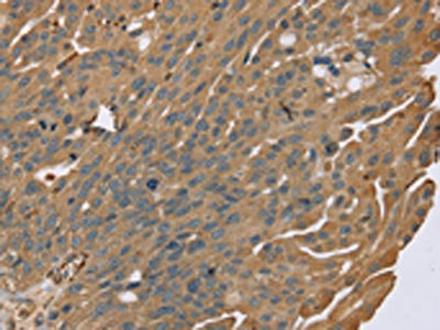 The image on the left is immunohistochemistry of paraffin-embedded Human breast cancer tissue using CSB-PA103365(ZMIZ1 Antibody) at dilution 1/40, on the right is treated with synthetic peptide. (Original magnification: x200)