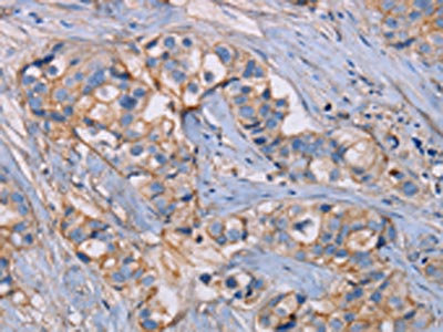 The image on the left is immunohistochemistry of paraffin-embedded Human breast cancer tissue using CSB-PA104968(GHITM Antibody) at dilution 1/30, on the right is treated with fusion protein. (Original magnification: x200)