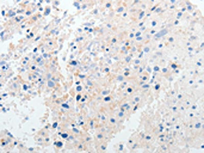 The image on the left is immunohistochemistry of paraffin-embedded Human ovarian cancer tissue using CSB-PA107290(PRMT5 Antibody) at dilution 1/50, on the right is treated with synthetic peptide. (Original magnification: x200)