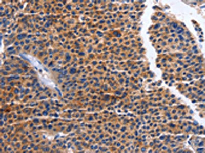 The image on the left is immunohistochemistry of paraffin-embedded Human liver cancer tissue using CSB-PA108299(MAP3K13 Antibody) at dilution 1/20, on the right is treated with fusion protein. (Original magnification: x200)