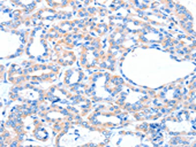 The image on the left is immunohistochemistry of paraffin-embedded Human thyroid cancer tissue using CSB-PA110823(ACOX1 Antibody) at dilution 1/20, on the right is treated with fusion protein. (Original magnification: x200)