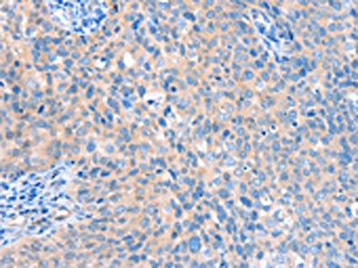The image on the left is immunohistochemistry of paraffin-embedded Human cervical cancer tissue using CSB-PA110823(ACOX1 Antibody) at dilution 1/20, on the right is treated with fusion protein. (Original magnification: x200)
