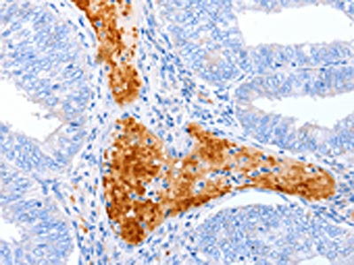 The image on the left is immunohistochemistry of paraffin-embedded Human cervical cancer tissue using CSB-PA117174(ENPP7 Antibody) at dilution 1/50, on the right is treated with synthetic peptide. (Original magnification: x200)